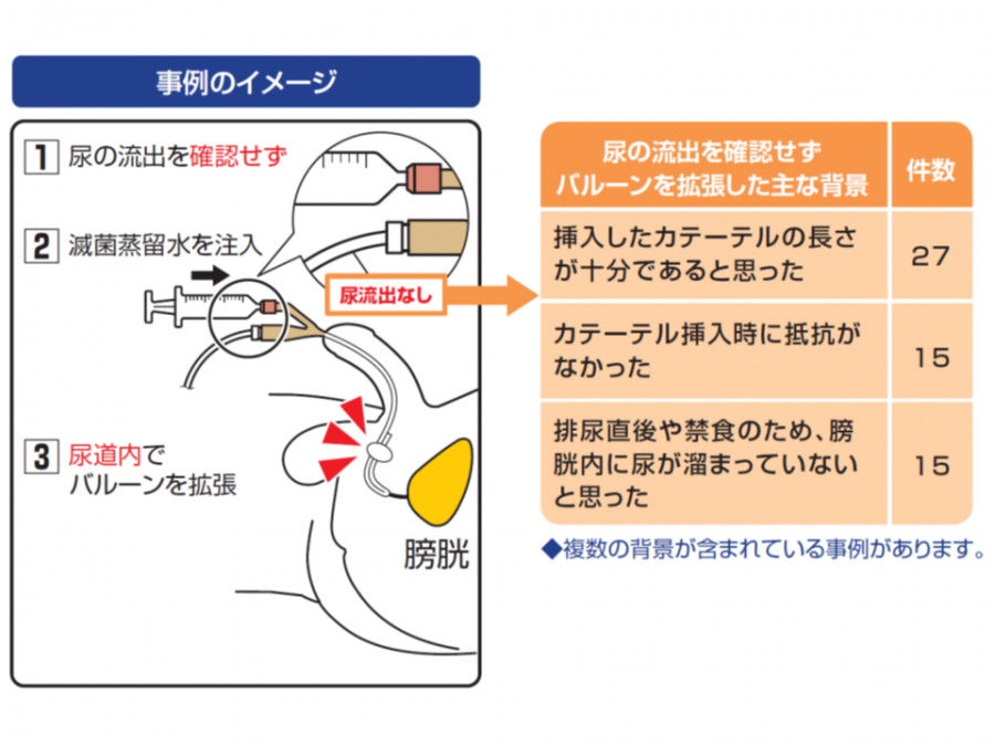 膀胱留置カテーテルによる尿道損傷、2013年以降に49件も発生―医療機能評価機構 | GemMed | データが拓く新時代医療